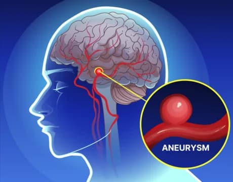 An image of brain aneurysm