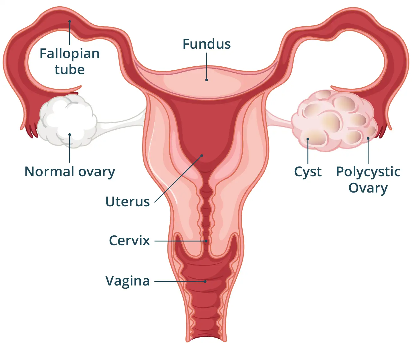 An image of PCOS
