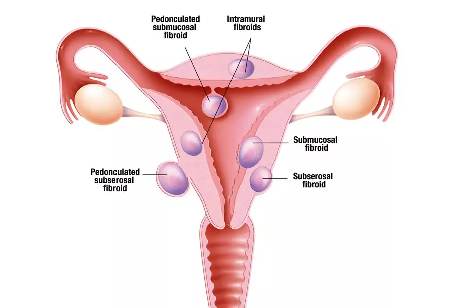 Diagram of the female reproductive tract showing the pathway of gonorrhea from cervix to fallopian tubes